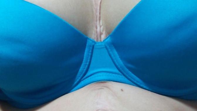 Who's sick of seeing unattainable perfect bodies? Show us your scars! What's the story behind them?