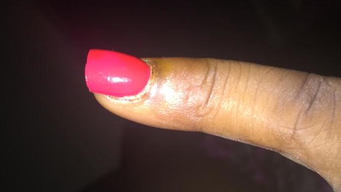 Infected finger?