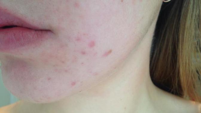 Please help me, major acne problem! Who has a solution?