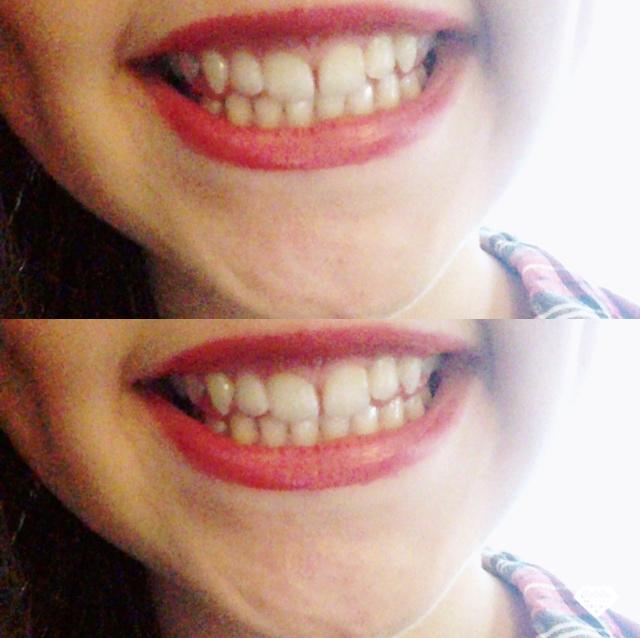 I'm 13 and afraid the gap between my two  front teeth won't end up closing I need opinions please?