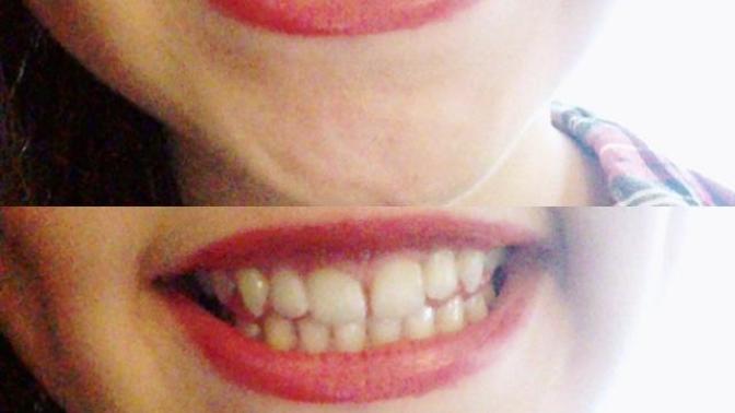 I'm 13 and afraid the gap between my two front teeth won't end up closing I need opinions please?