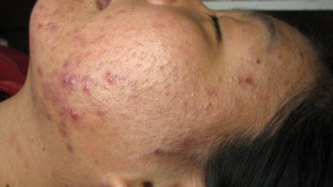 What could be the reason for my lack of motivation to tackle my oily skin and acne problems?