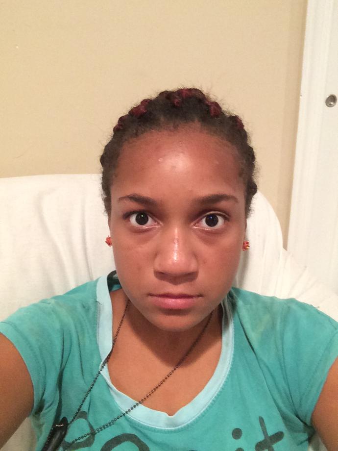 Can tea tree oil help with hyperpigmentation?