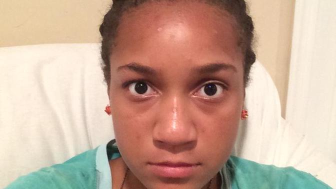 Can tea tree oil help with hyperpigmentation?