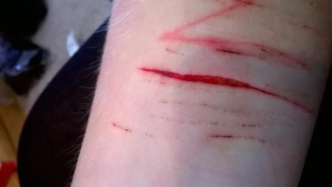Do I need stitches?