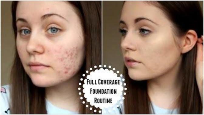 Can a girl be pretty with acne scars?