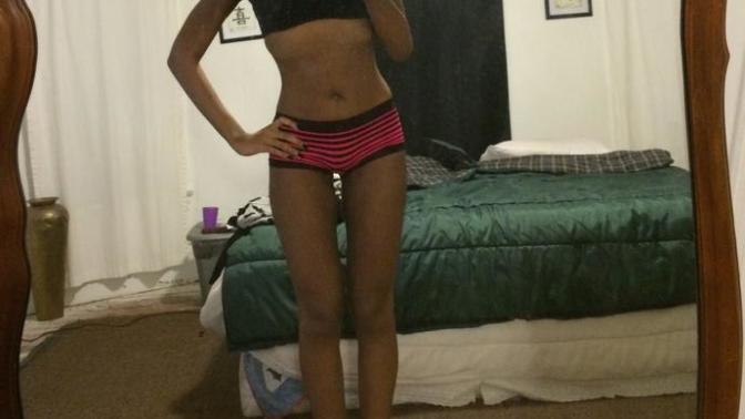 Did I look horrible when I had anorexia?