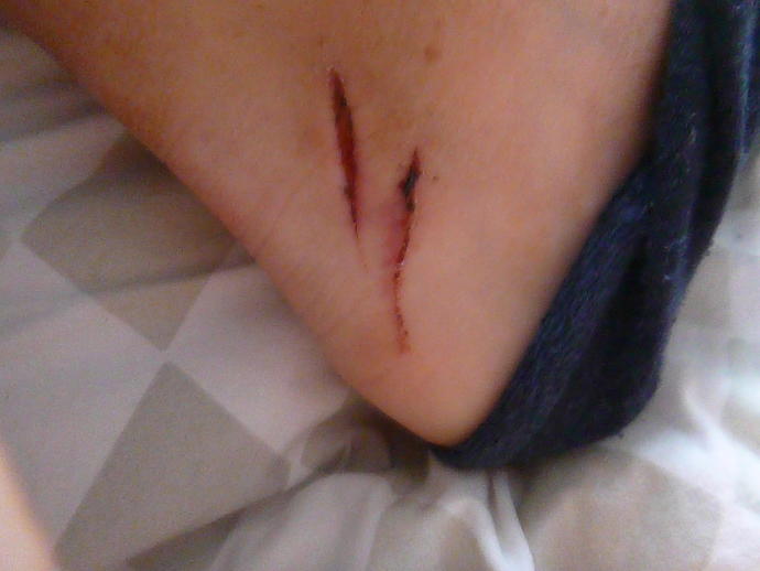 Do I need stitches/ is it infected?