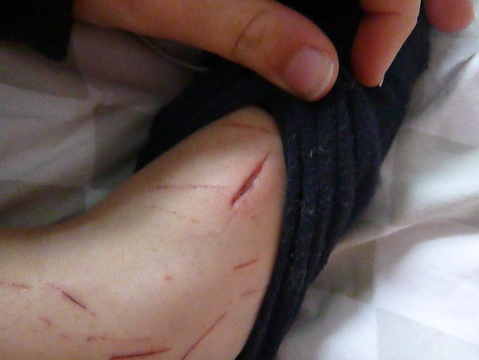 do i need stitches/ is it infected?