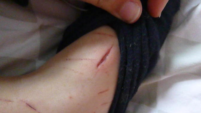 Do I need stitches/ is it infected?