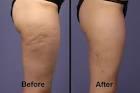 Guys, do you care about cellulite?