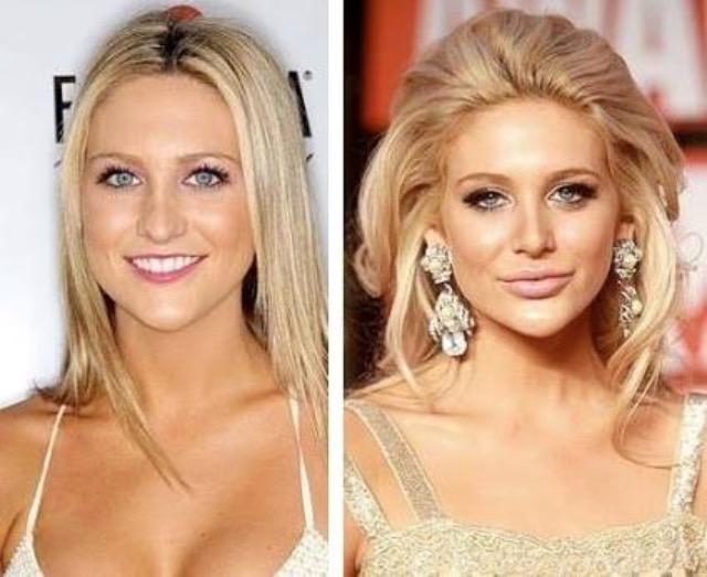 Why have so many white women had their lips done?