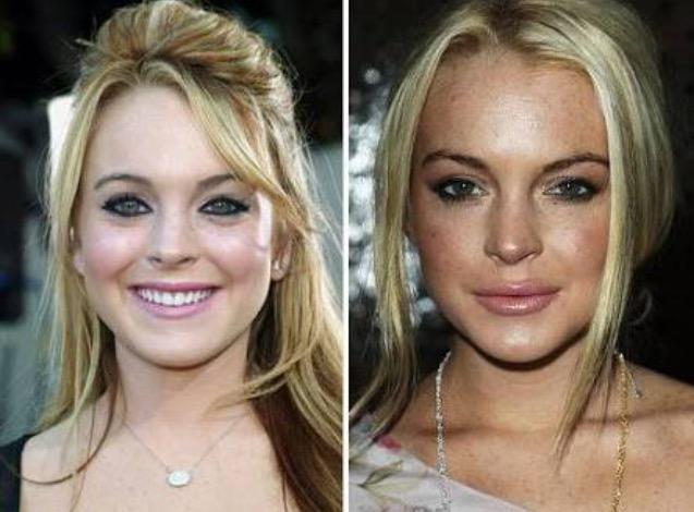 Why have so many white women had their lips done?
