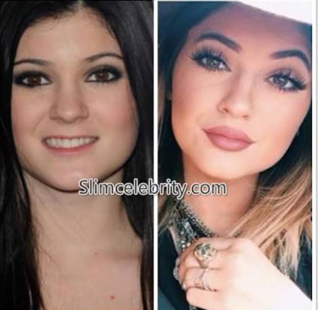 Why have so many white women had their lips done?