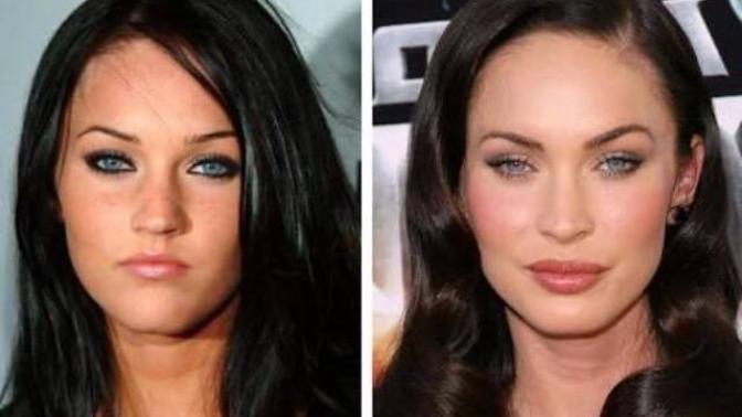 Why have so many white women had their lips done?