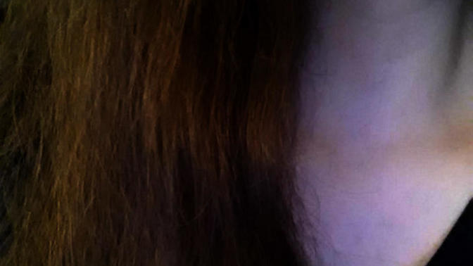 Acne scars - please help?