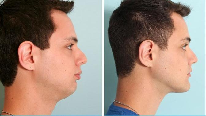Getting facial surgery tomorrow, how do I calm down?