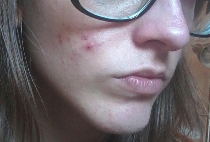 Any Acne clearing tips?