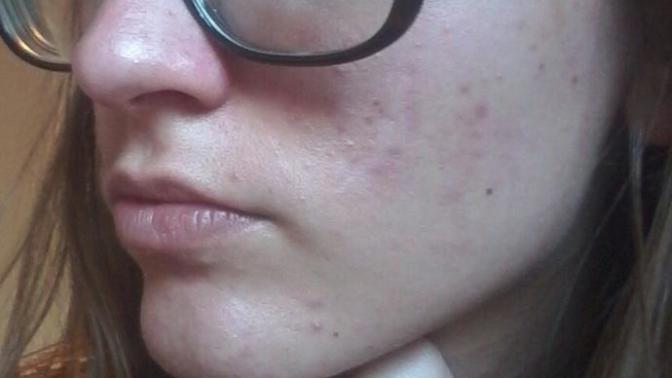 Any Acne clearing tips?