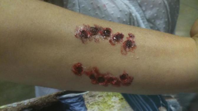 Are there any GAG-ers (among the active ones) who have been bitten by a Zombie?