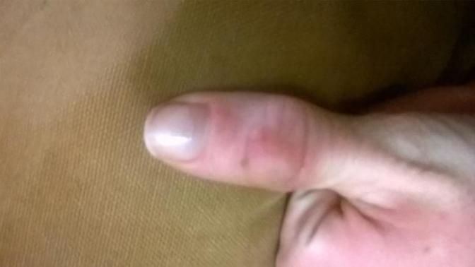 Is there a way to reverse the damage I have done to my thumbs?