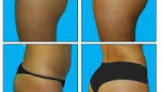 All about that bass! With the big butt craze, would you be willing to date a girl with butt implants?