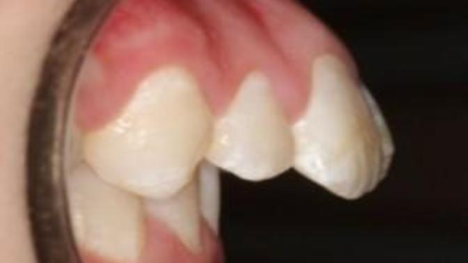 Buck teeth turn off or indifferent?