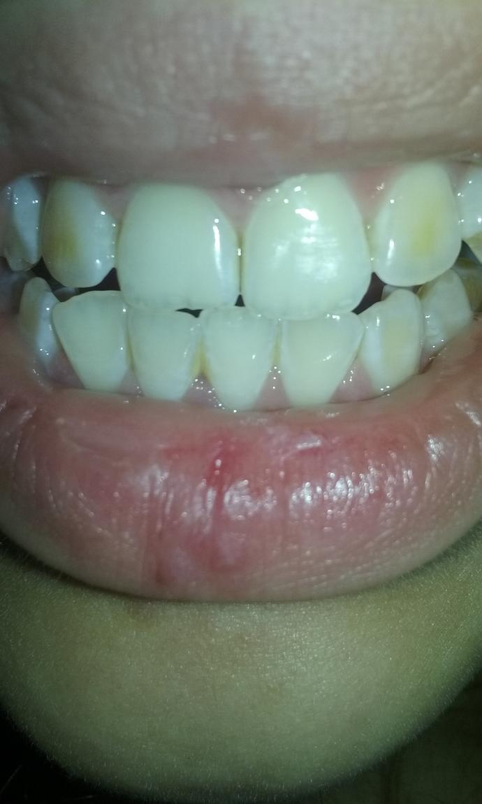 Yellow teeth , Can I ever get white teeth please don't judge (4 pics)?