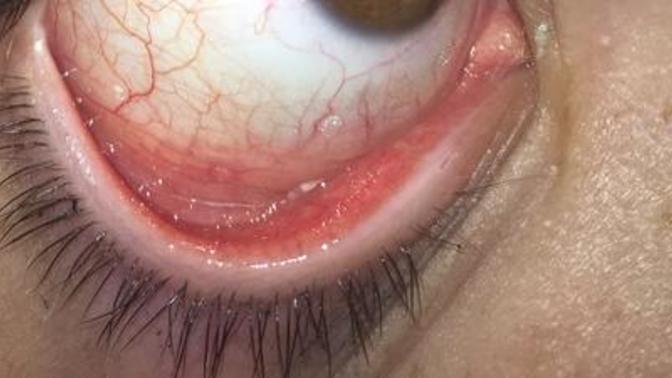 Does anybody experience the same type of discharge with a stringy like texture?