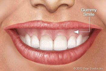 Opinion on gummy smile?  