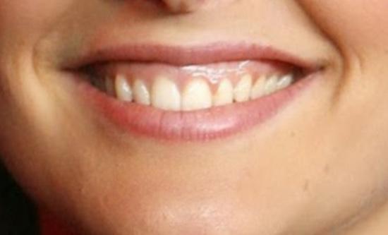 Opinion on gummy smile?