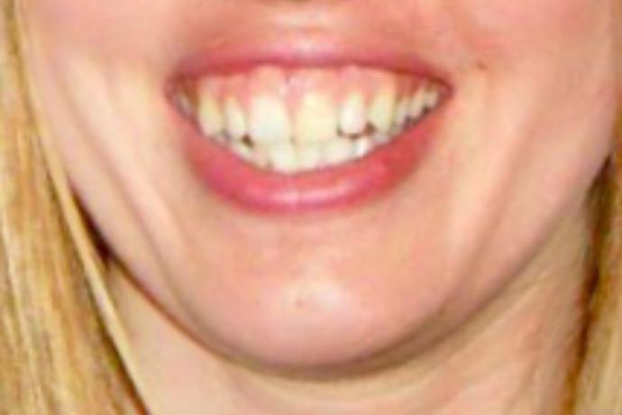 Opinion on gummy smile?