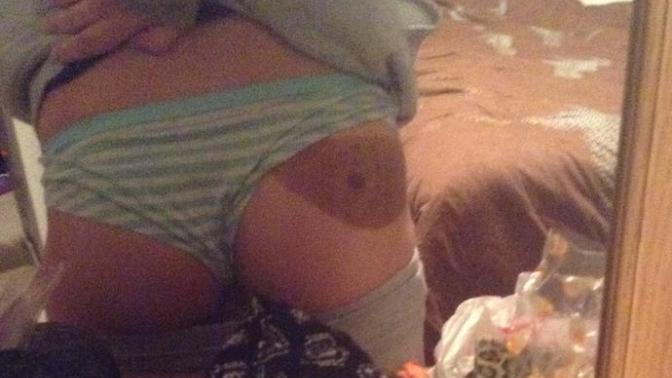 HUGE birthmark on butt a turn off?