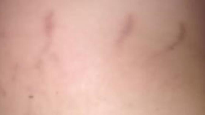 Girls, would these stretch marks gross you out? (pic inside) im embarrassed to let a girl I care about see me naked because of this?