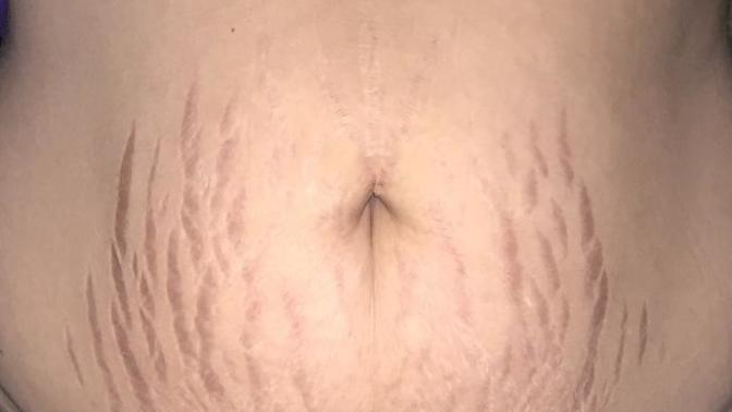 Are my stretch marks a huge turnoff?