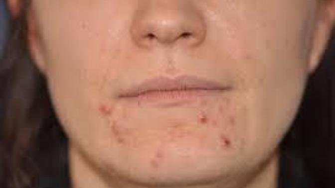 If a girl has moderate acne, do guys still prefer her without makeup?