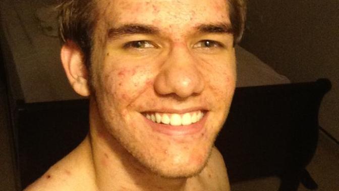 Can a girl touch my body with acne?