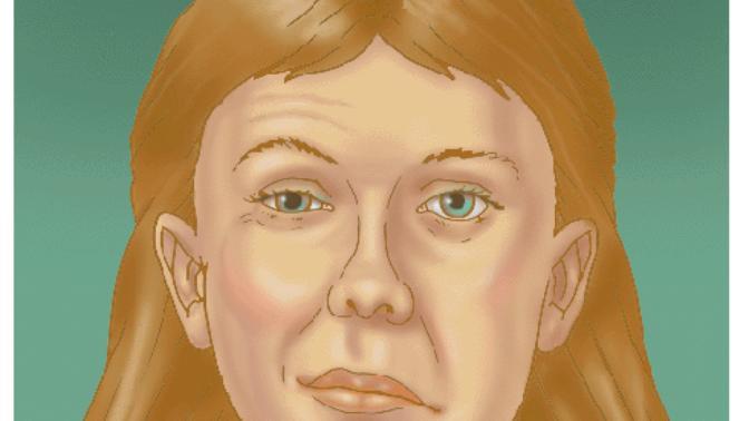 Guys, would you date a girl thats had Bell Palsy and has some facial paralysis as a result?