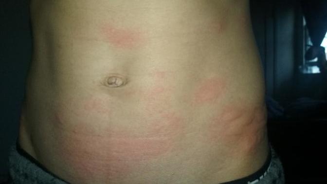 Is this chicken pox or allergy reaction?