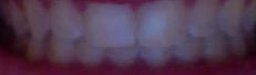 How to whiten teeth?