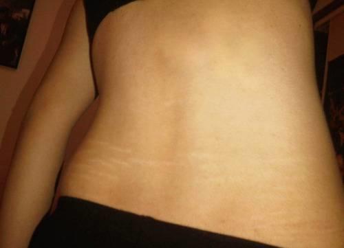 Guys do you think stretch marks are unattractive?