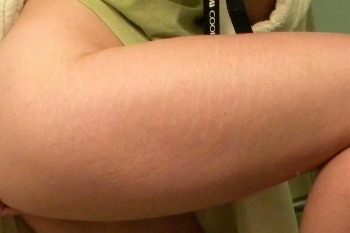 Guys do you think stretch marks are unattractive?