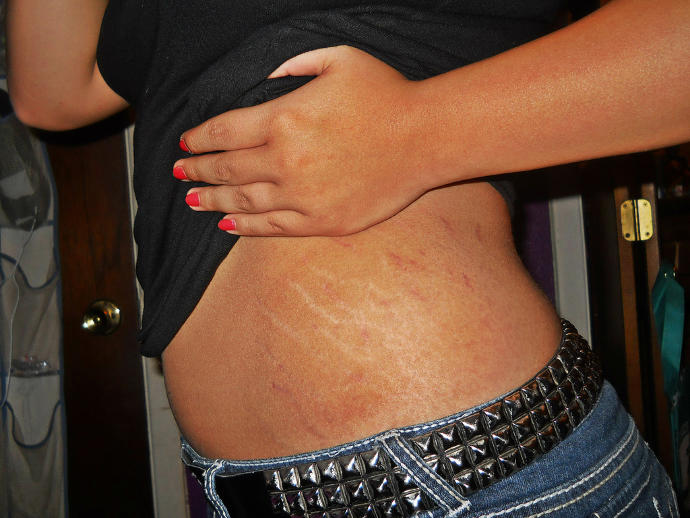 Guys do you think stretch marks are unattractive?