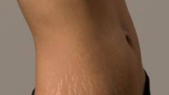 Guys do you think stretch marks are unattractive?