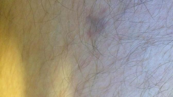 What is this spot on my leg? Should I be worried?
