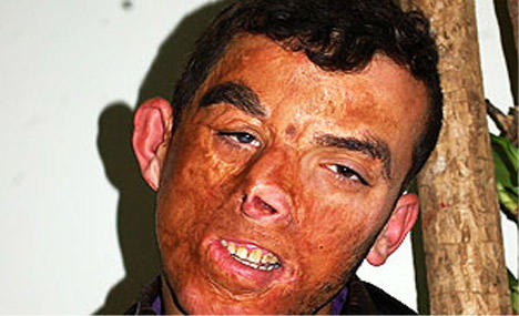 Girls, would you still date a man if his face was seriously burned and was molested as a child or would you reject him?
