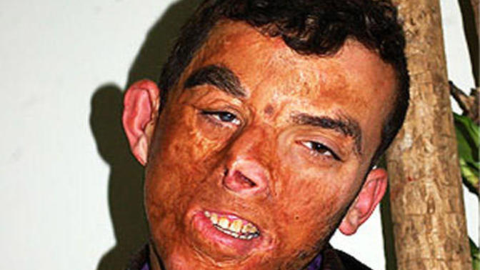 Girls, would you still date a man if his face was seriously burned and was molested as a child or would you reject him?