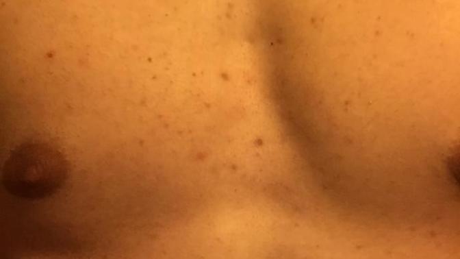 Girls, Im insecure about my acne, how bad is it?