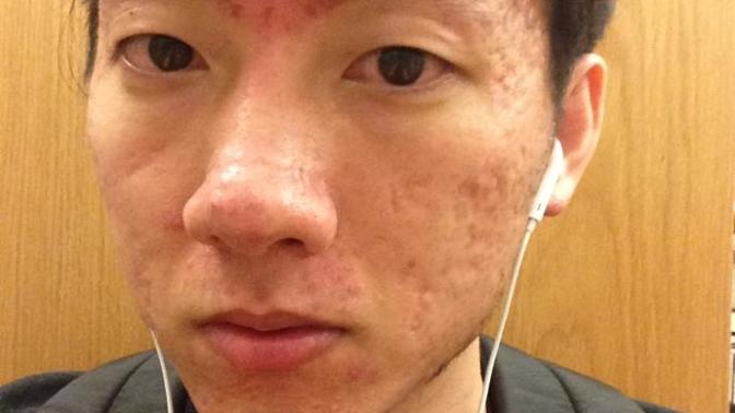Girls depsite my acne scars will you still L. O. V. E me?