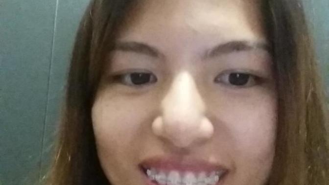 Guys would you date a girl with braces like this ( pics)?